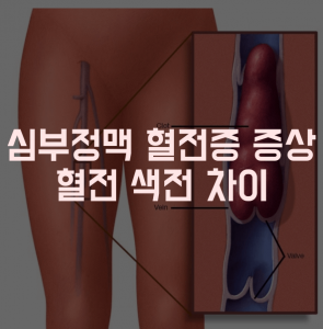 심부정맥-혈전증-폐-색전증-썸네일