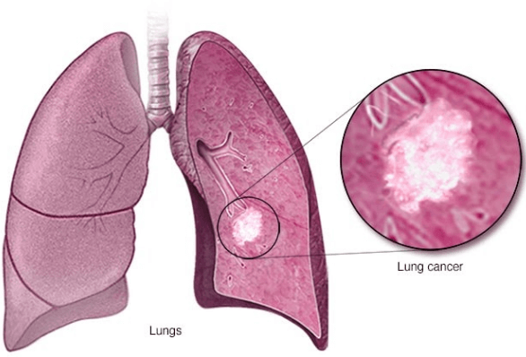 폐암 진단